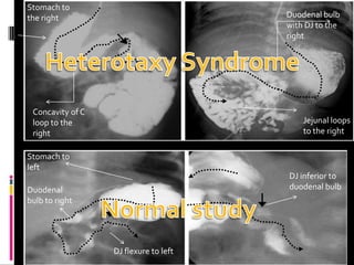 Duodenal bulb
with DJ to the
right
Jejunal loops
to the right
Stomach to
the right
Concavity of C
loop to the
right
Stomach to
left
Duodenal
bulb to right
DJ flexure to left
DJ inferior to
duodenal bulb
 