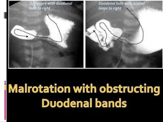 DJ flexure with duodunal
bulb to right
Duodenal bulb with jejunal
loops to right
 