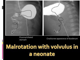 Proximal dilated
stomach
Crockscrew appearance of duodenum
 
