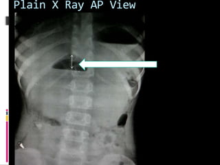 Plain X Ray AP View
 