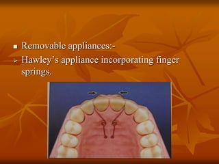  Removable appliances:-
Hawley’s appliance incorporating finger
springs.