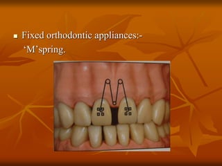  Fixed orthodontic appliances:-
‘M’spring.