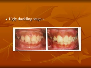  Ugly duckling stage:-