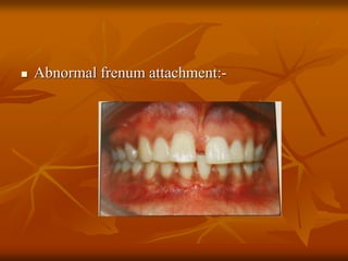  Abnormal frenum attachment:-