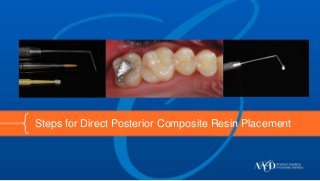 Steps for Direct Posterior Composite Resin Placement

 
