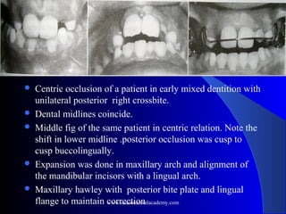 Midline shift /certified fixed orthodontic courses by Indian dental