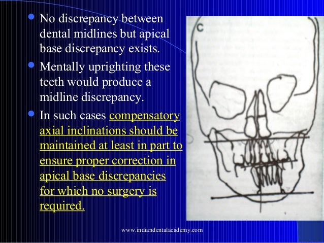 Midline shift /certified fixed orthodontic courses by Indian dental a…