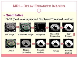 MRI – DELAY ENHANCED IMAGING

 Quantitative
  FACT (Feature Analysis and Combined Threshold )method




 MR Image   Contoured Image   Histogram   Image Pre-     2SD
                                          Processing   Threshol
                                                          d




   Output       Region         Feature                 Feature
                                            FWHM
               contouring      analysis                analysis
 