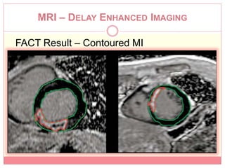 MRI – DELAY ENHANCED IMAGING

FACT Result – Contoured MI
 