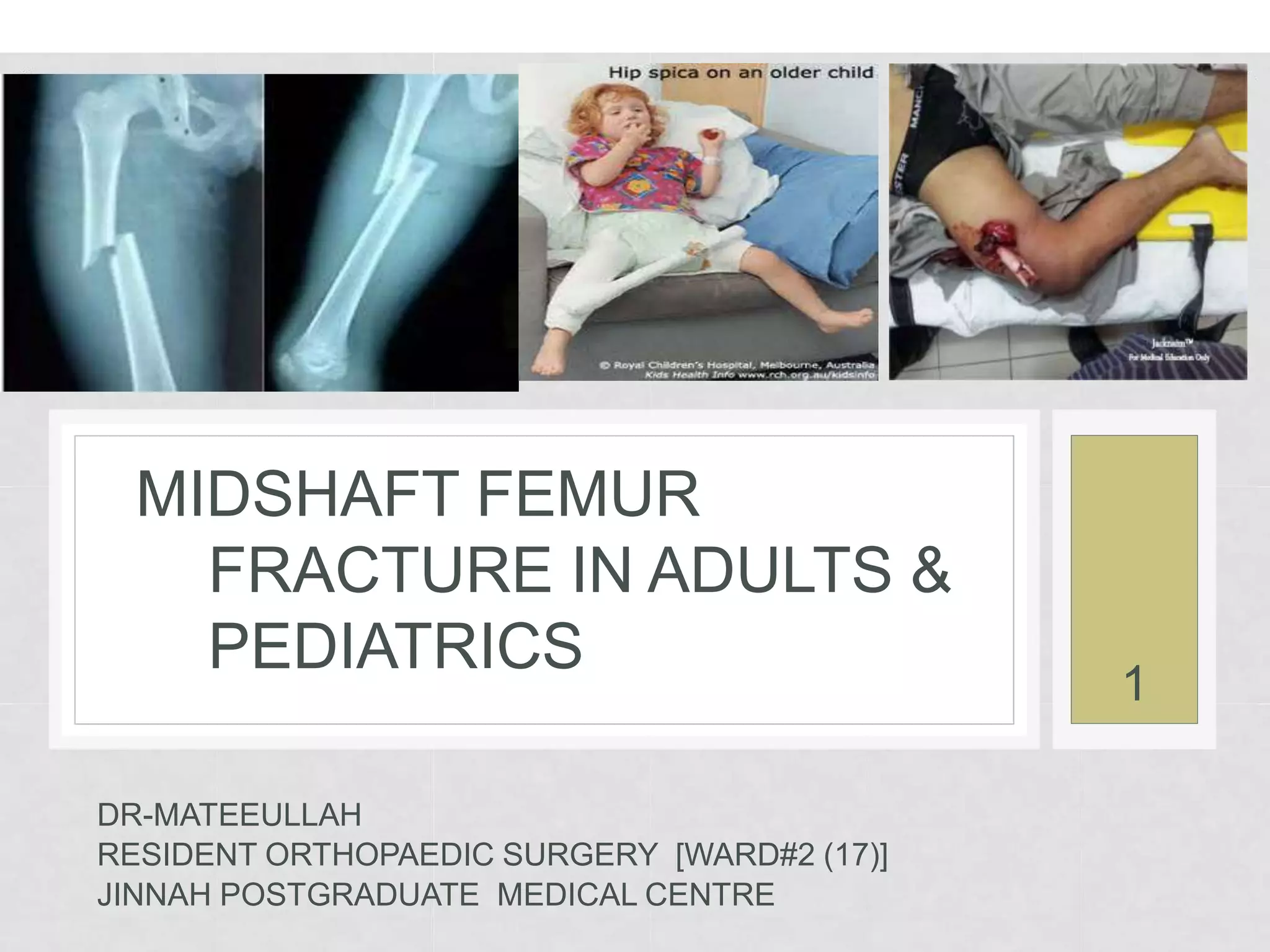 Midshaft Femur Fracture PPTX