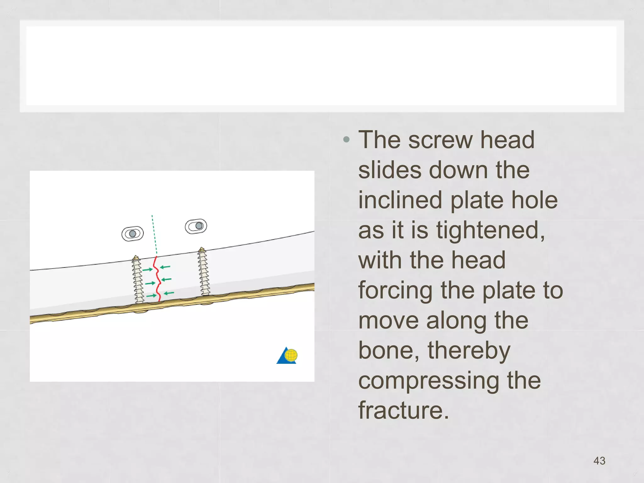 midshaft-femur-fracture-pptx