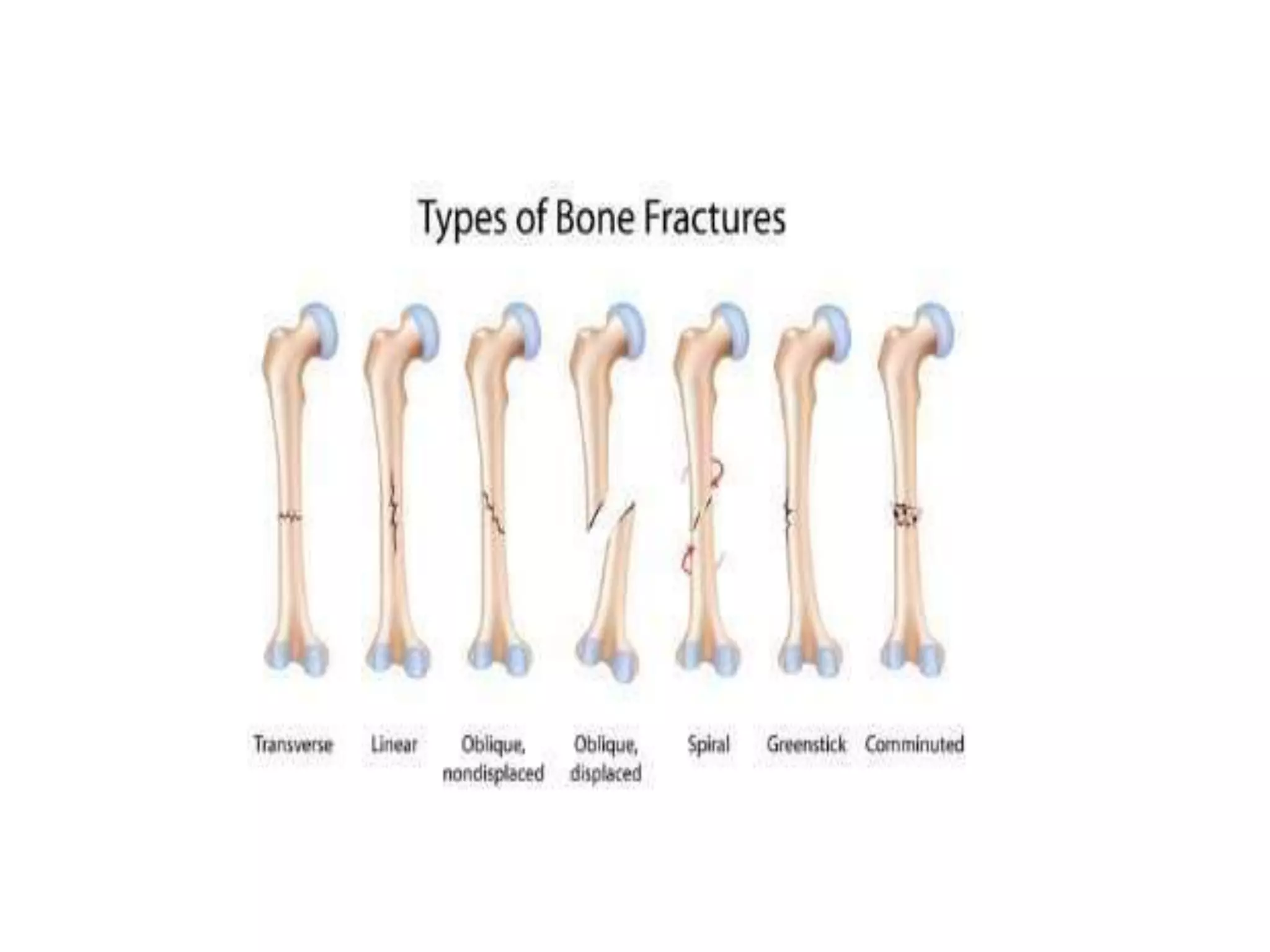 midshaft-femur-fracture-pptx
