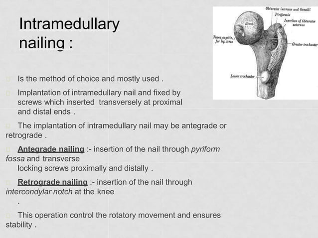 midshaft-femur-fracture-pptx