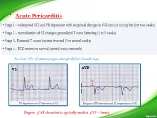 • Acute Pericarditis
Degree of ST elevation is typically modest (0.5 – 1mm).
Less than 50% of patients progress through all four classical stages
 