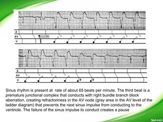 Sinus rhythm is present at rate of about 65 beats per minute. The third beat is a
premature junctional complex that conducts with right bundle branch block
aberration, creating refractoriness in the AV node (gray area in the AV level of the
ladder diagram) that prevents the next sinus impulse from conducting to the
ventricle. The failure of the sinus impulse to conduct creates a pause
 