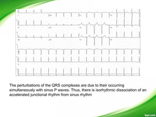 The perturbations of the QRS complexes are due to their occurring
simultaneously with sinus P waves. Thus, there is isorhythmic dissociation of an
accelerated junctional rhythm from sinus rhythm
 