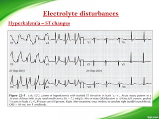 Electrolyte disturbances
Hyperkalemia – ST changes
 