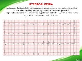 An increased extracellular calcium concentration shortens the ventricular action
potential duration by shortening phase 2 of the action potential.
Hypercalcemia sometimes produces a high takeoff of the ST segment in leads V1 and
V2 and can thus simulate acute ischemia
HYPERCALCEMIA
 