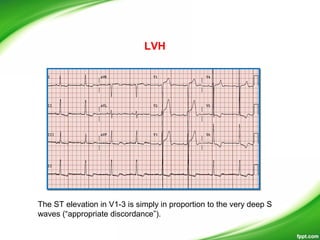 The ST elevation in V1-3 is simply in proportion to the very deep S
waves (“appropriate discordance”).
LVH
 