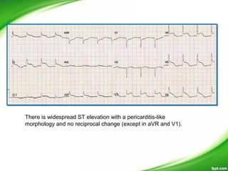 There is widespread ST elevation with a pericarditis-like
morphology and no reciprocal change (except in aVR and V1).
 