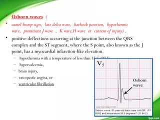 • Osborn waves (
• camel-hump sign, late delta wave, hathook junction, hypothermic
wave, prominent J wave , K wave,H wave or current of injury) .
• positive deflections occurring at the junction between the QRS
complex and the ST segment, where the S point, also known as the J
point, has a myocardial infarction-like elevation.
–  hypothermia with a temperature of less than 32 C (90 F),
–  hypercalcemia, 
– brain injury,
– vasospastic angina, or
– ventricular fibrillation
 
