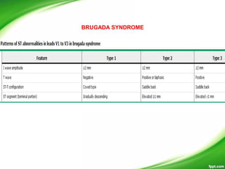 BRUGADA SYNDROME
 