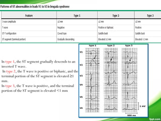 In type 1, the ST segment gradually descends to an
inverted T wave.
In type 2, the T wave is positive or biphasic, and the
terminal portion of the ST segment is elevated ≥1
mm.
In type 3, the T wave is positive, and the terminal
portion of the ST segment is elevated <1 mm
 