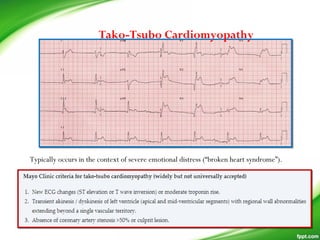 Tako-Tsubo Cardiomyopathy
Typically occurs in the context of severe emotional distress (“broken heart syndrome”).
 