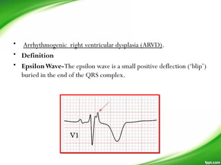 •  Arrhythmogenic right ventricular dysplasia (ARVD).
• Definition
• EpsilonWave-The epsilon wave is a small positive deflection (‘blip’)
buried in the end of the QRS complex.
 