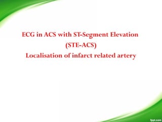 ECG in ACS with ST-Segment Elevation
(STE-ACS)
Localisation of infarct related artery
 