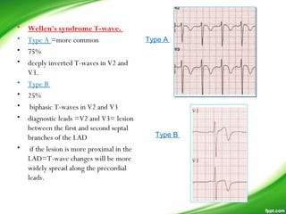• Wellen's syndrome T-wave.
• Type A =more common
• 75%
• deeply inverted T-waves in V2 and
V3.
• Type B
• 25%
• biphasic T-waves in V2 and V3
• diagnostic leads =V2 and V3= lesion
between the first and second septal
branches of the LAD
• if the lesion is more proximal in the
LAD=T-wave changes will be more
widely spread along the precordial
leads.
Type A
Type B
 