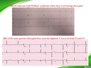 EKG in someone with Wellens' syndrome when they were having chest pain
EKG of the same person when pain free, note the biphasic T waves in leads V2 and V3
 
