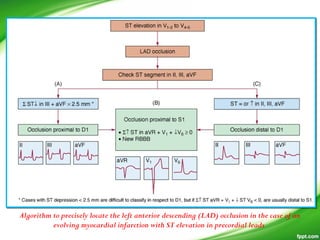 Algorithm to precisely locate the left anterior descending (LAD) occlusion in the case of an
evolving myocardial infarction with ST elevation in precordial leads
 
