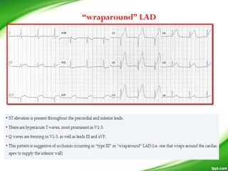 “wraparound” LAD
 