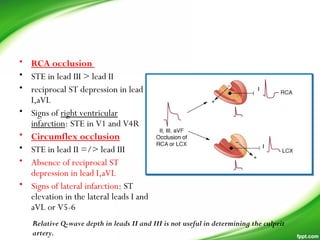 • RCA occlusion 
• STE in lead III > lead II
• reciprocal ST depression in lead
I,aVL
• Signs of right ventricular
infarction: STE in V1 and V4R
• Circumflex occlusion
• STE in lead II =/> lead III
• Absence of reciprocal ST
depression in lead I,aVL
• Signs of lateral infarction: ST
elevation in the lateral leads I and
aVL or V5-6
Relative Q-wave depth in leads II and III is not useful in determining the culprit
artery.
 