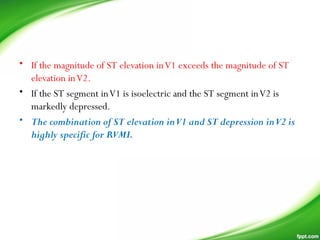 • If the magnitude of ST elevation inV1 exceeds the magnitude of ST
elevation inV2.
• If the ST segment inV1 is isoelectric and the ST segment inV2 is
markedly depressed.
• The combination of ST elevation inV1 and ST depression inV2 is
highly specific for RVMI.
 