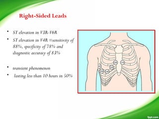 • ST elevation in V3R-V6R
• ST elevation in V4R =sensitivity of
88%, specificity of 78% and
diagnostic accuracy of 83%
• transient phenomenon
• lasting less than 10 hours in 50%
Right-Sided Leads
 