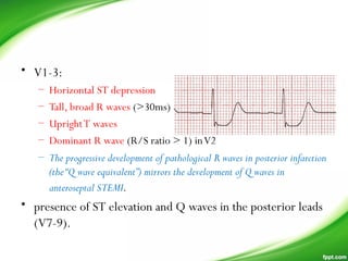 • V1-3:
– Horizontal ST depression
– Tall, broad R waves (>30ms)
– UprightT waves
– Dominant R wave (R/S ratio > 1) inV2
– The progressive development of pathological R waves in posterior infarction
(the“Q wave equivalent”) mirrors the development of Q waves in
anteroseptal STEMI. 
• presence of ST elevation and Q waves in the posterior leads
(V7-9).
 