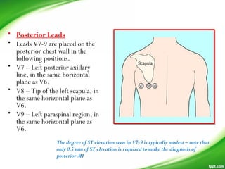 • Posterior Leads
• Leads V7-9 are placed on the
posterior chest wall in the
following positions.
• V7 – Left posterior axillary
line, in the same horizontal
plane as V6.
• V8 – Tip of the left scapula, in
the same horizontal plane as
V6.
• V9 – Left paraspinal region, in
the same horizontal plane as
V6.
The degree of ST elevation seen in V7-9 is typically modest – note that
only 0.5 mm of ST elevation is required to make the diagnosis of
posterior MI
 
