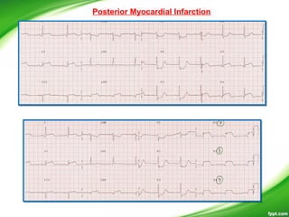 Posterior Myocardial Infarction
 
