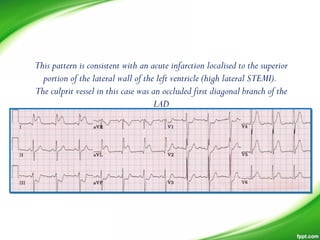 This pattern is consistent with an acute infarction localised to the superior
portion of the lateral wall of the left ventricle (high lateral STEMI).
The culprit vessel in this case was an occluded first diagonal branch of the
LAD
 