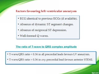 Factors favouring left ventricular aneurysm
The ratio of T-wave to QRS complex amplitude 
 