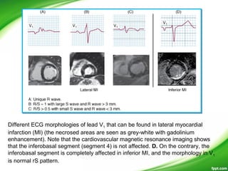 Different ECG morphologies of lead V1 that can be found in lateral myocardial
infarction (MI) (the necrosed areas are seen as grey-white with gadolinium
enhancement). Note that the cardiovascular magnetic resonance imaging shows
that the inferobasal segment (segment 4) is not affected. D. On the contrary, the
inferobasal segment is completely affected in inferior MI, and the morphology in V1
is normal rS pattern.
 