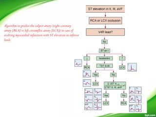 Algorithm to predict the culprit artery (right coronary
artery [RCA] vs left circumflex artery [LCX]) in case of
evolving myocardial infarction with ST elevation in inferior
leads
 
