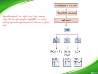 Algorithm to predict the culprit artery (right coronary
artery [RCA] vs left circumflex artery [LCX]) in case of
evolving myocardial infarction with ST elevation in inferior
leads
 
