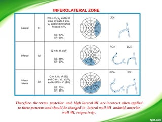 INFEROLATERAL ZONE
Therefore, the terms posterior and high lateral MI are incorrect when applied
to these patterns and should be changed to lateral wall MI andmid-anterior
wall MI, respectively.
 