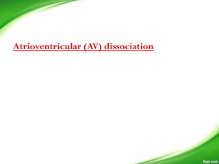 Atrioventricular (AV) dissociation
 