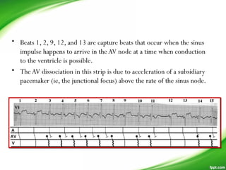 • Beats 1, 2, 9, 12, and 13 are capture beats that occur when the sinus
impulse happens to arrive in theAV node at a time when conduction
to the ventricle is possible.
• TheAV dissociation in this strip is due to acceleration of a subsidiary
pacemaker (ie, the junctional focus) above the rate of the sinus node.
 