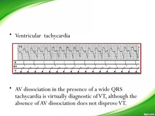 • Ventricular tachycardia
• AV dissociation in the presence of a wide QRS
tachycardia is virtually diagnostic ofVT, although the
absence ofAV dissociation does not disproveVT.
 