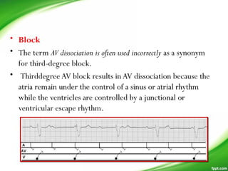 • Block
• The term AV dissociation is often used incorrectly as a synonym
for third-degree block.
• ThirddegreeAV block results inAV dissociation because the
atria remain under the control of a sinus or atrial rhythm
while the ventricles are controlled by a junctional or
ventricular escape rhythm.
 